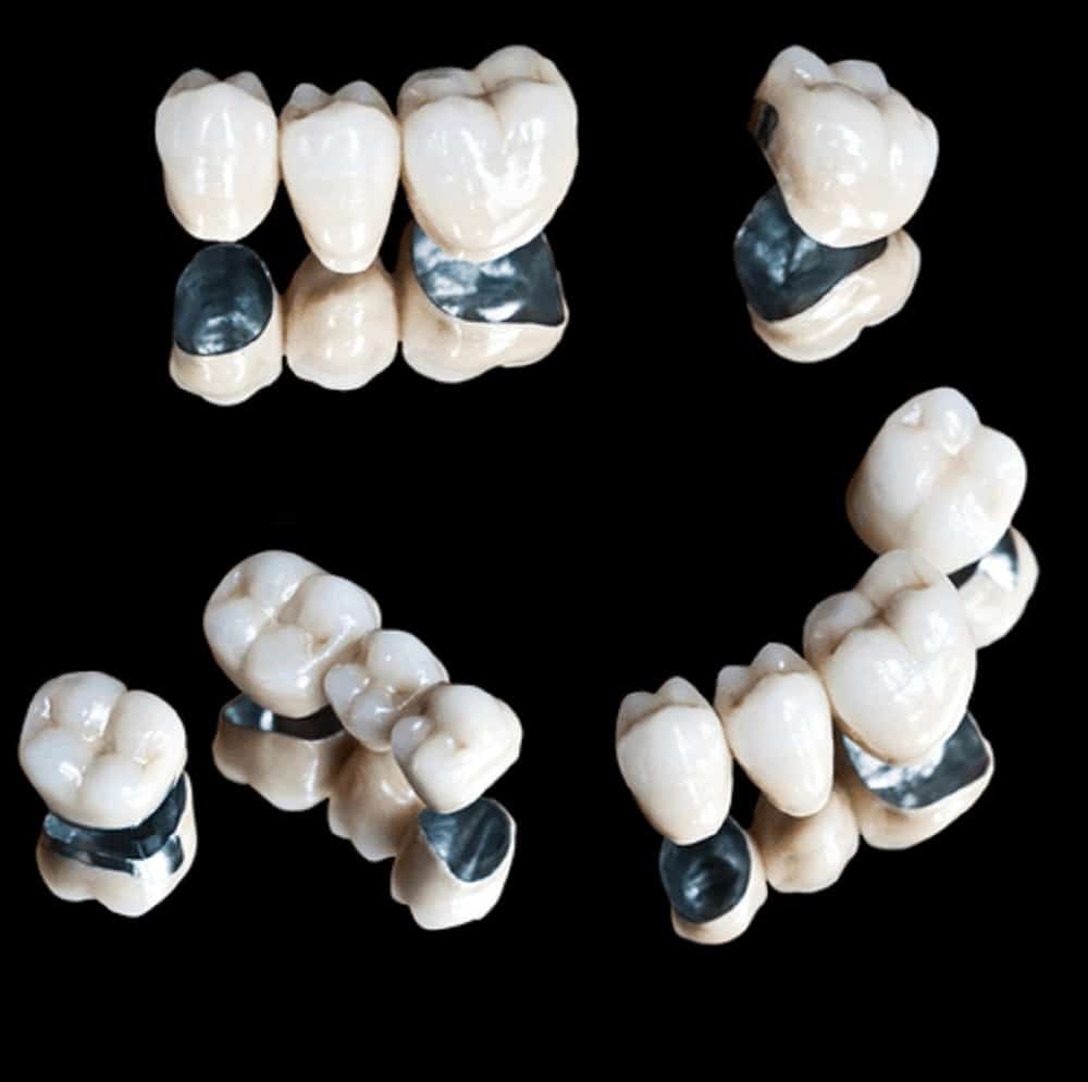 dental crowns what you may not know