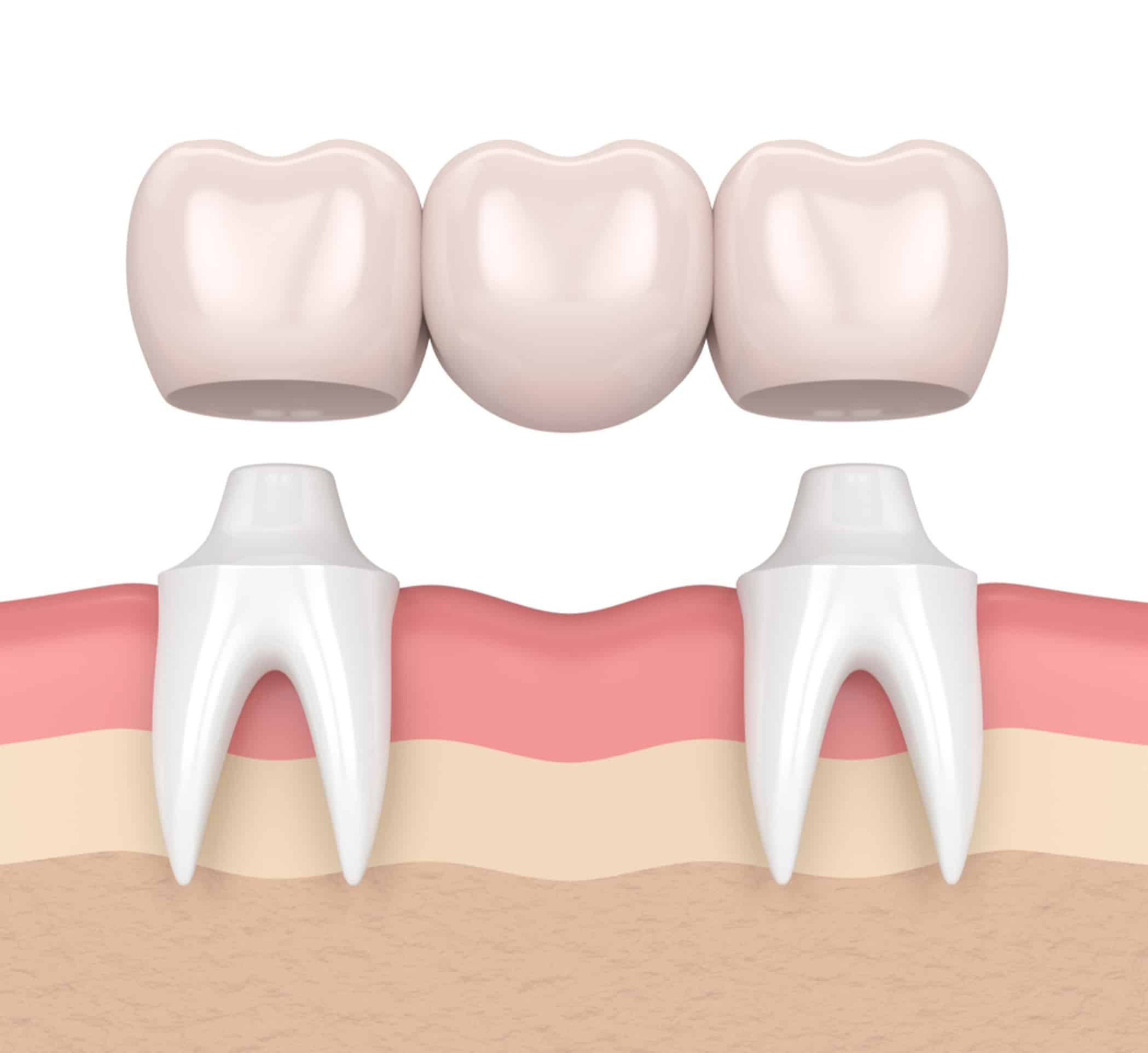 an introduction to dental bridges