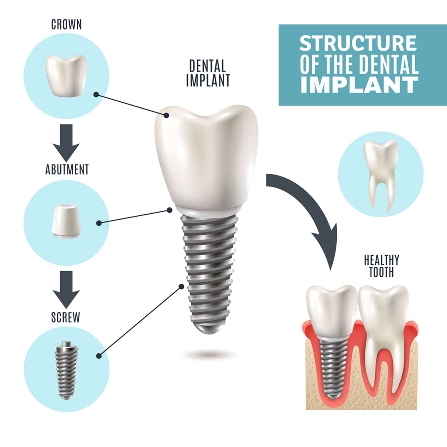 can I have all my teeth replaced with dental implants