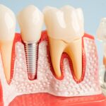 How Long Do Dental Implants Last? Factors That Affect Longevity