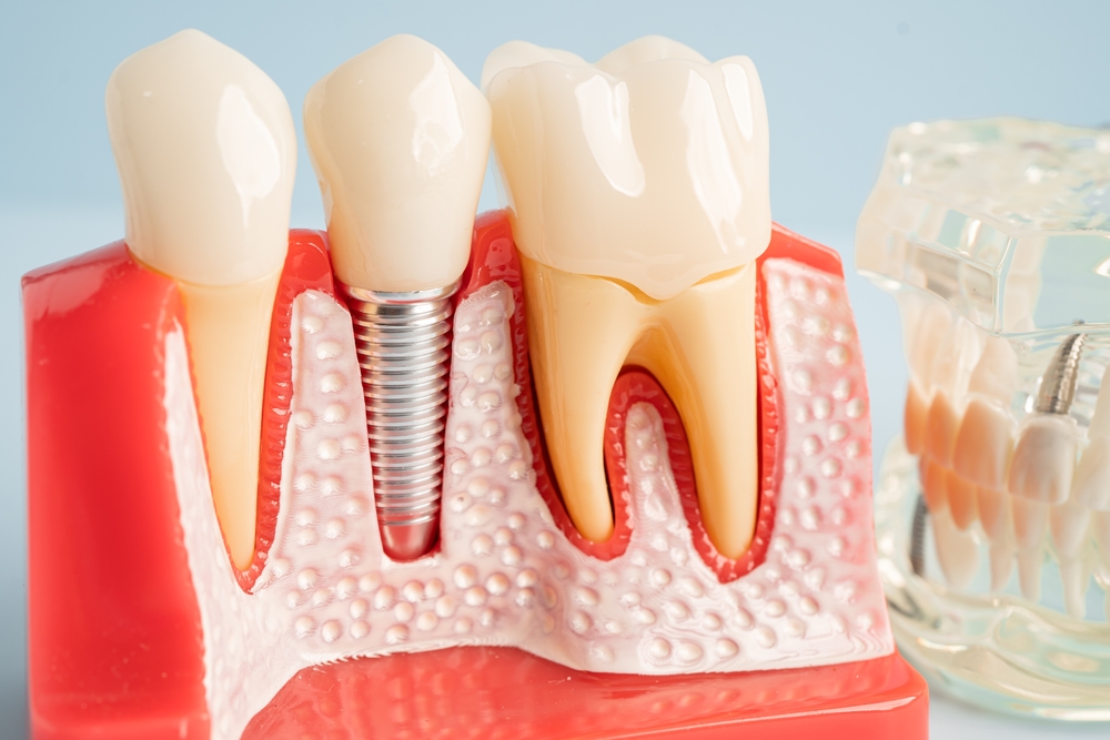 How Long Do Dental Implants Last? Factors That Affect Longevity